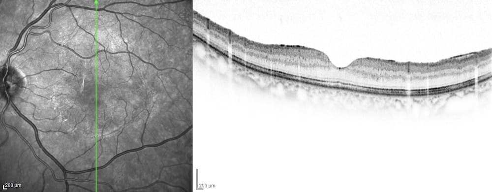 黄斑円孔手術後
