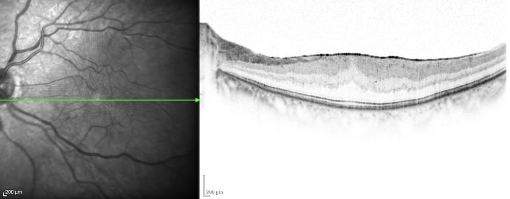 網膜前膜手術前