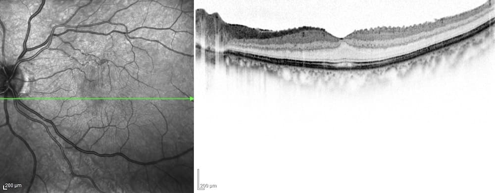 網膜前膜手術後