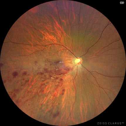 網膜静脈閉塞症