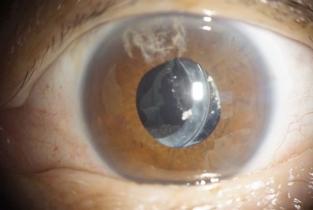 眼内レンズ亜脱臼