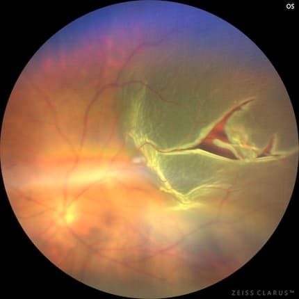 網膜剥離