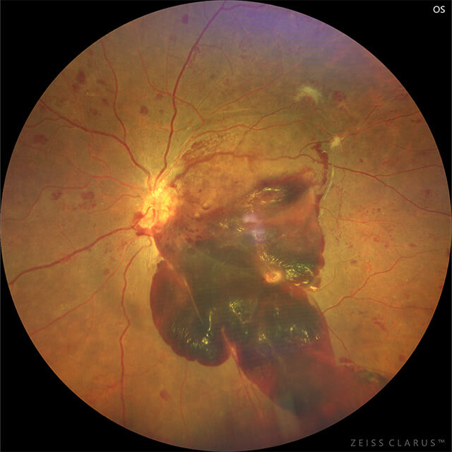 糖尿病網膜症 術前