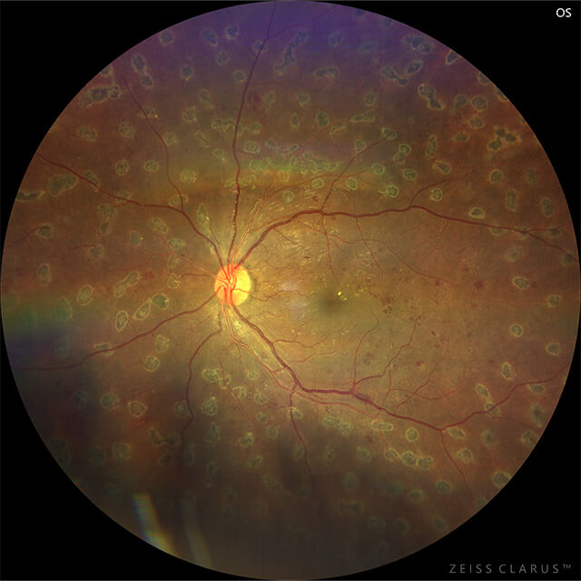 糖尿病網膜症 術後